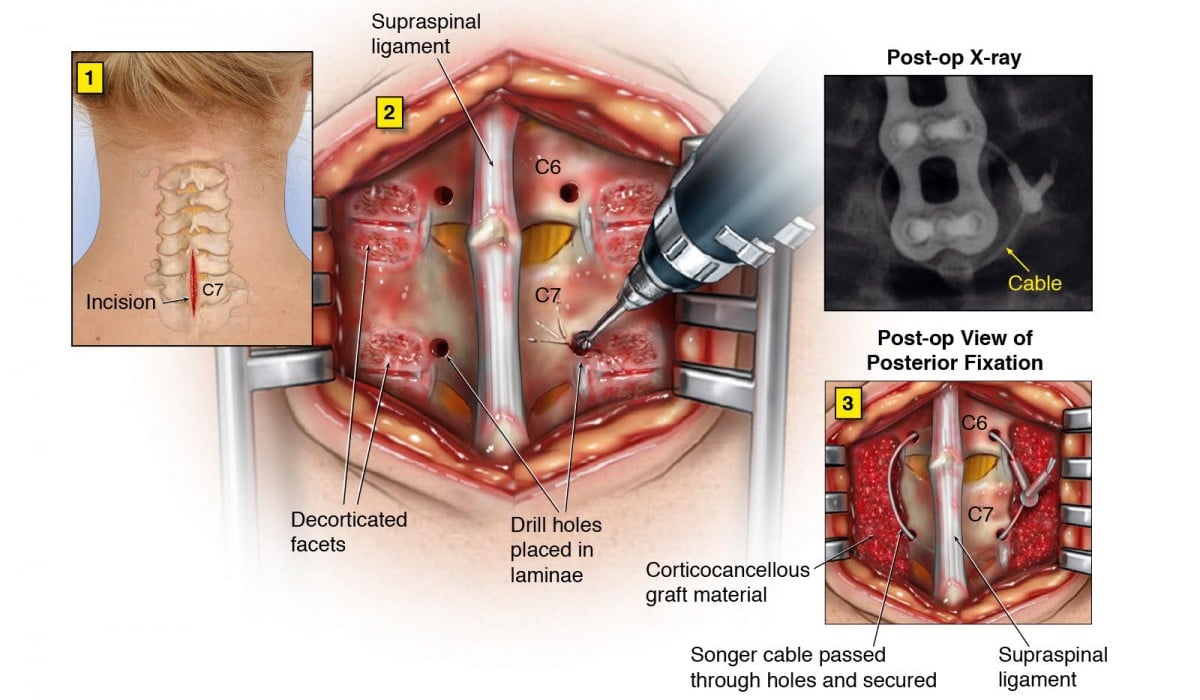 Posterior Cervical Spine Fusion Surgery Posterior Cervical Spine Fusion Surgery