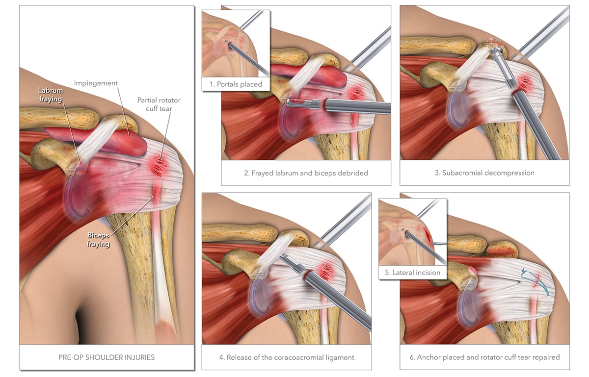 Rotator Cuff Surgery Rotator Cuff Surgery