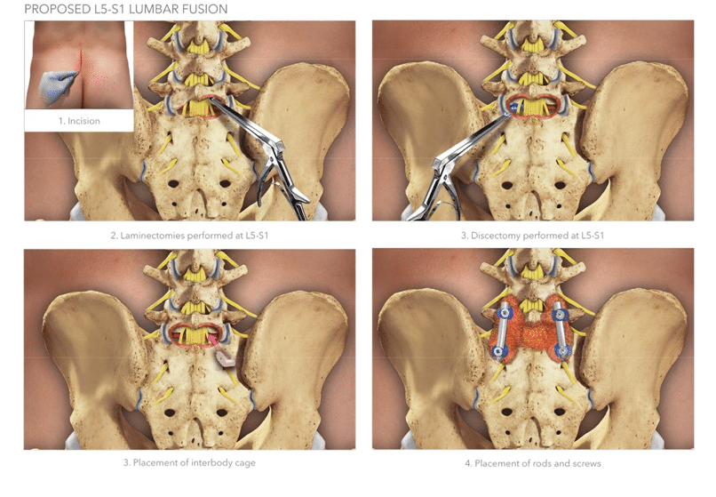 Catastrophic Back & Spinal Injuries from Car Crashes