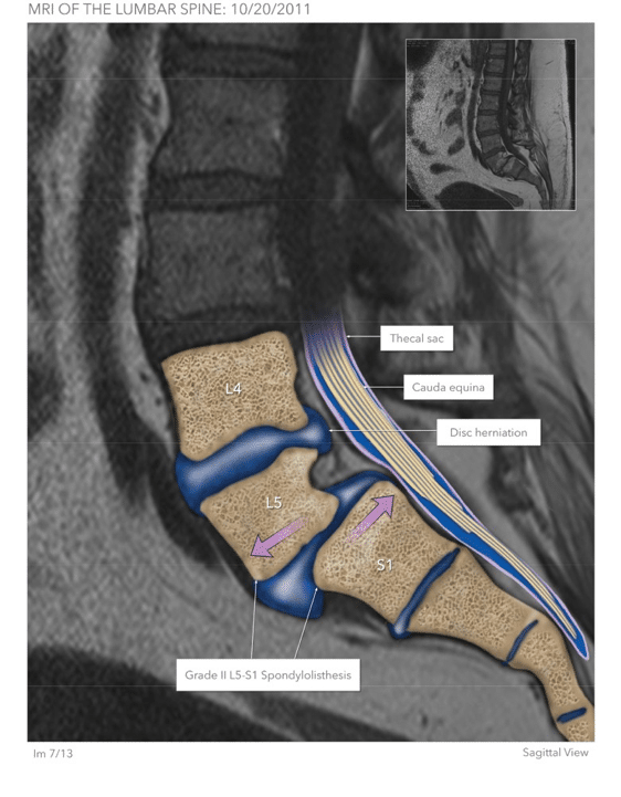 Spinal cord injuries in Oklahoma