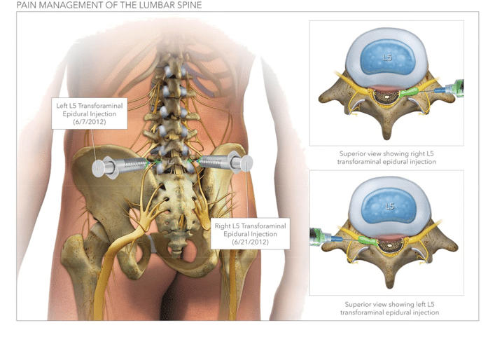 Spinal Injuries from Car Crashes