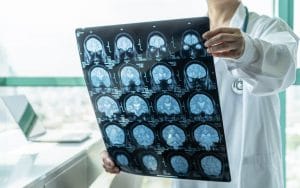 Coronavirus Linked to Neurological Problems