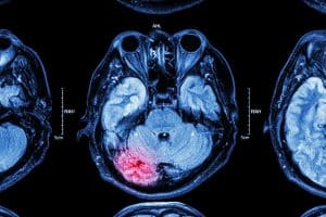 Understanding the True Cost of Traumatic Brain Injuries