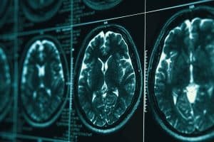 What Is a Diffuse Axonal Brain Injury? 