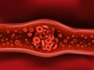 How Dangerous Are Blood Clots?