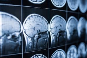 Delayed Brain Injury Symptoms